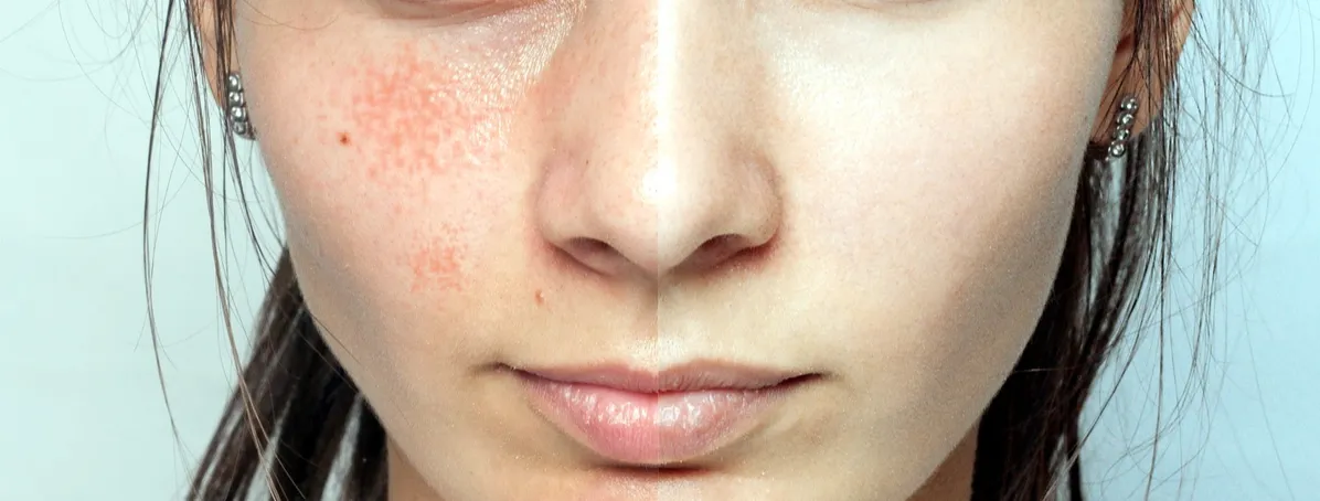 Глубокий пилинг кожи лица - преимущества и противопоказания проведения процедуры