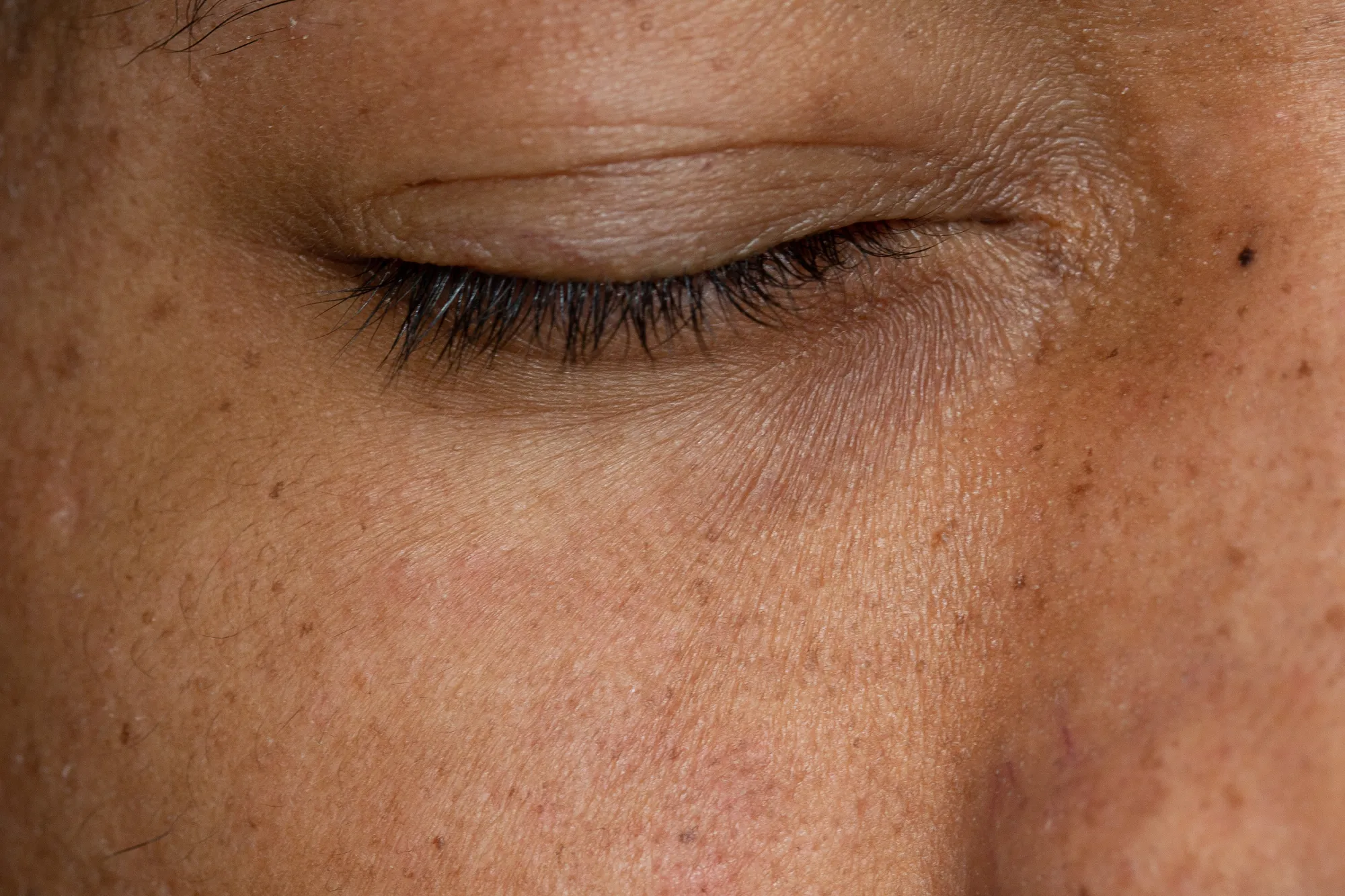 Процедуры от пигментации лица: эффективный способ борьбы с кожными пигментными пятнами