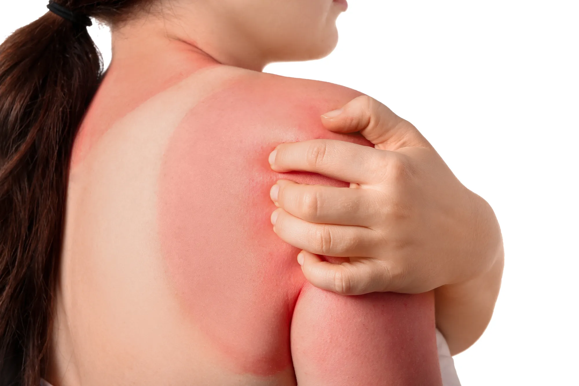 Повреждение кожи от сжигания солнцем: опасности загара и пути к здоровой коже