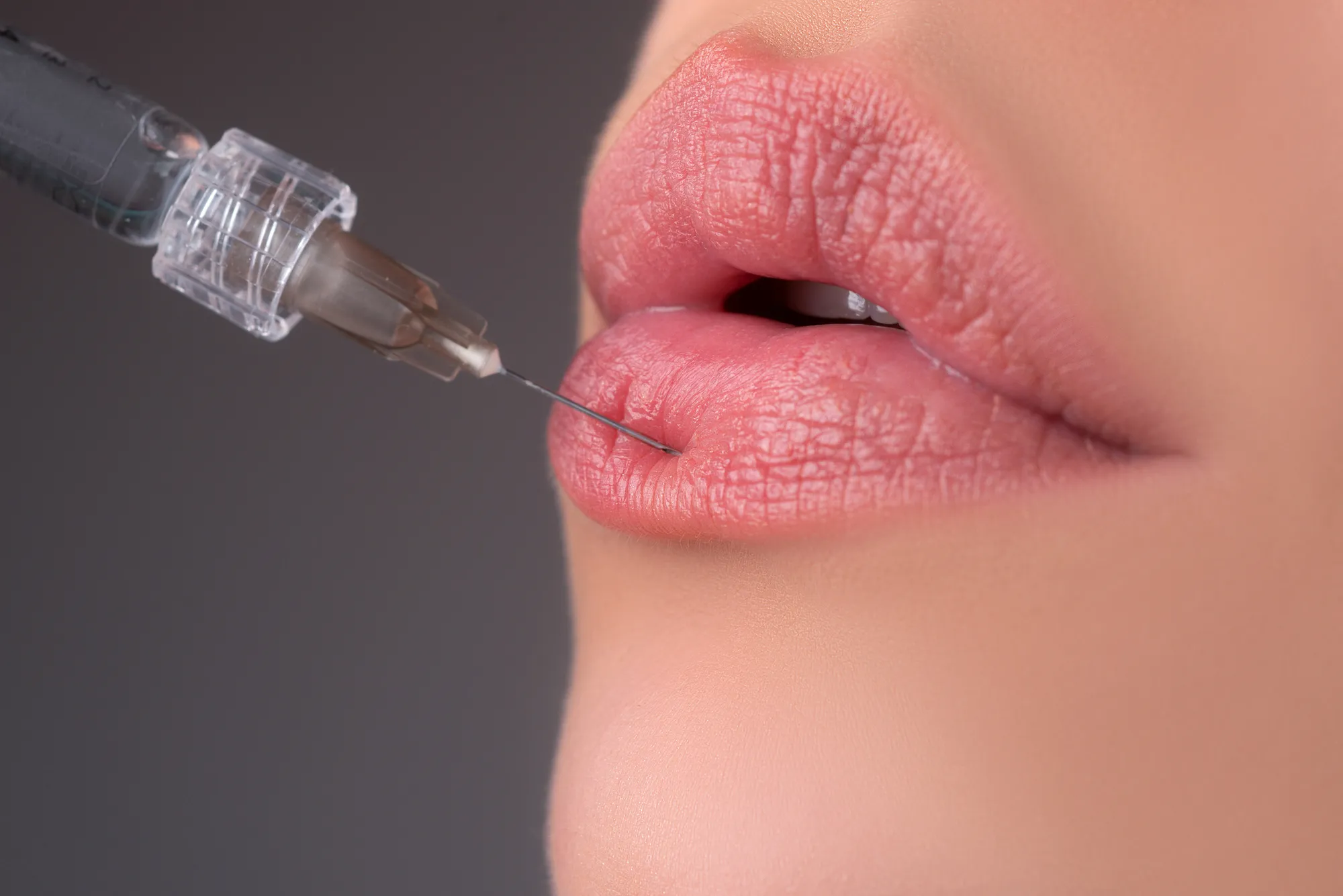 Инъекции гиалуроновой кислоты для увеличения объема губ: все, что вам нужно знать